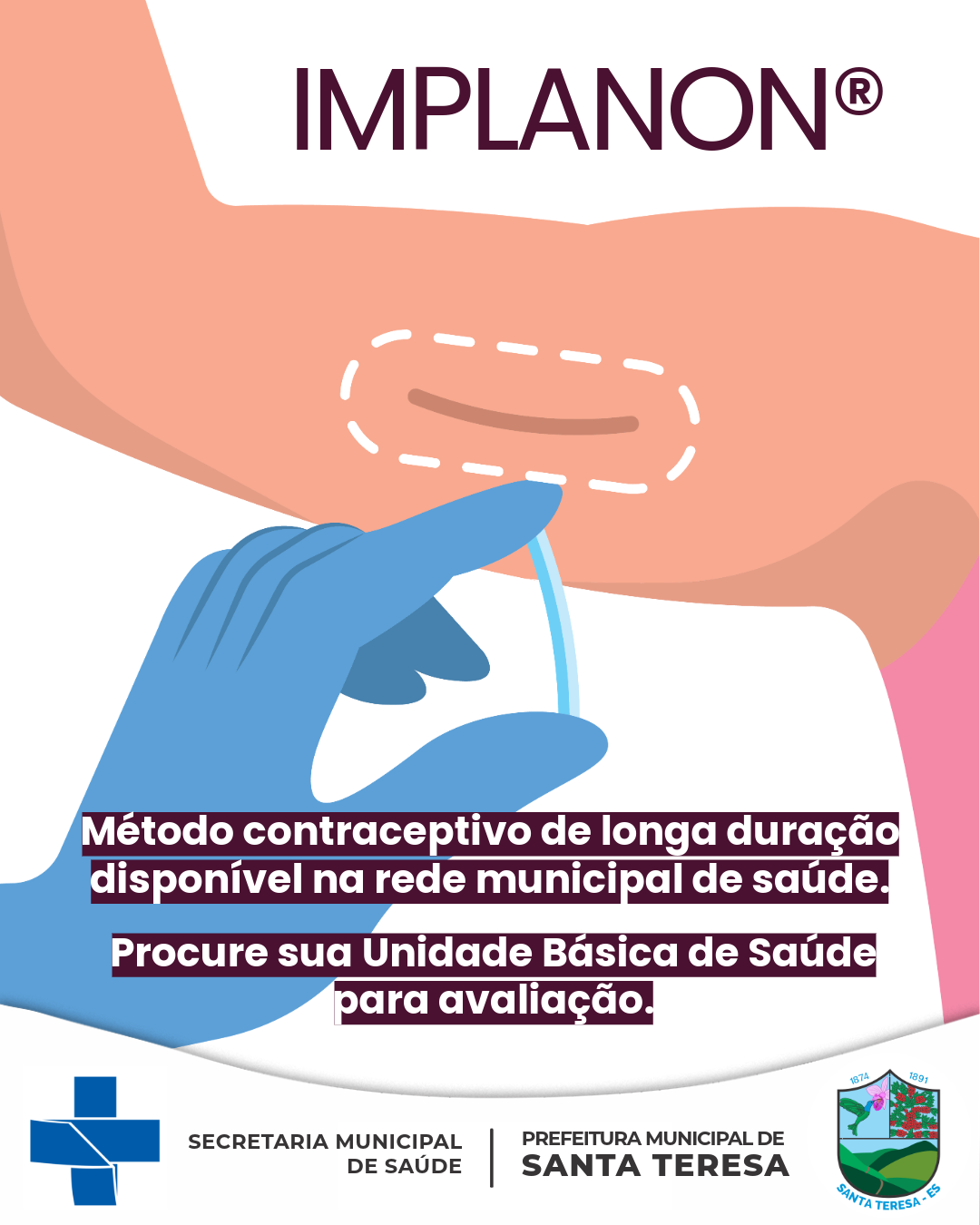 Santa Teresa amplia o acesso a método contraceptivo de longa duração na rede municipal de saúde